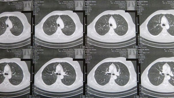ct-thorax
